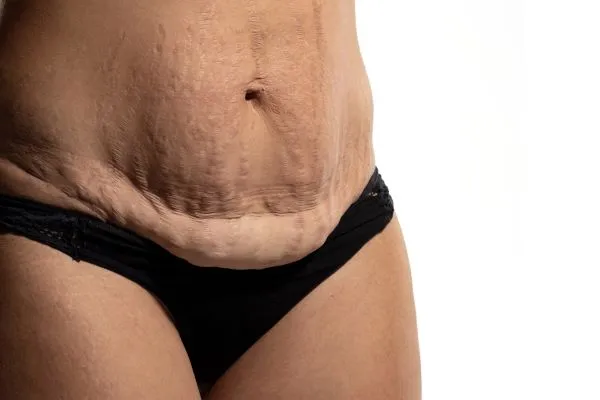 The Science of Skin Tightening 1 The science behind skin tightening Midlands picture of a woman's sagging skin on the stomach